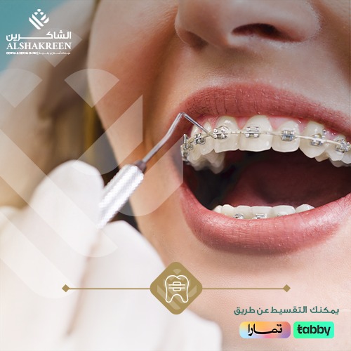 تقويم الاسنان | عيادات الشاكرين
